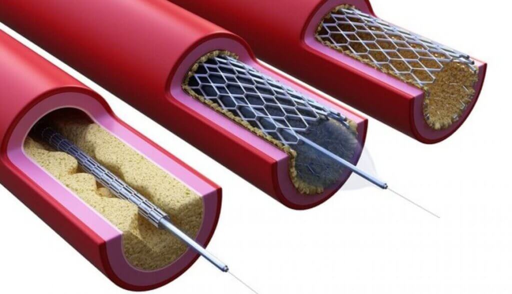 6 Ways to Improve Medical Grinding Polishing