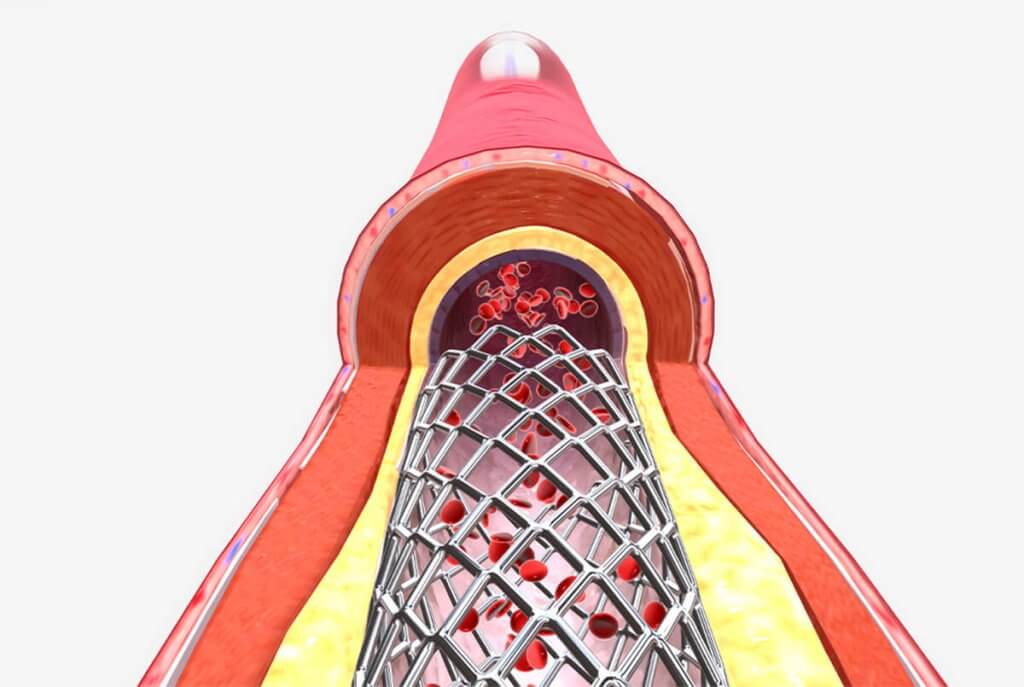 Medizinische Implantate