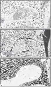 Figure 20.3. The ternary eutectic (α-Fe C-Fe P) in gray cast iron revealed by etching a) in picral and nital to “outline” the phases b) boiling alkaline sodium picrate to color the cementite. c) boiling Murakami’s reagent to color the phosphide (200X).